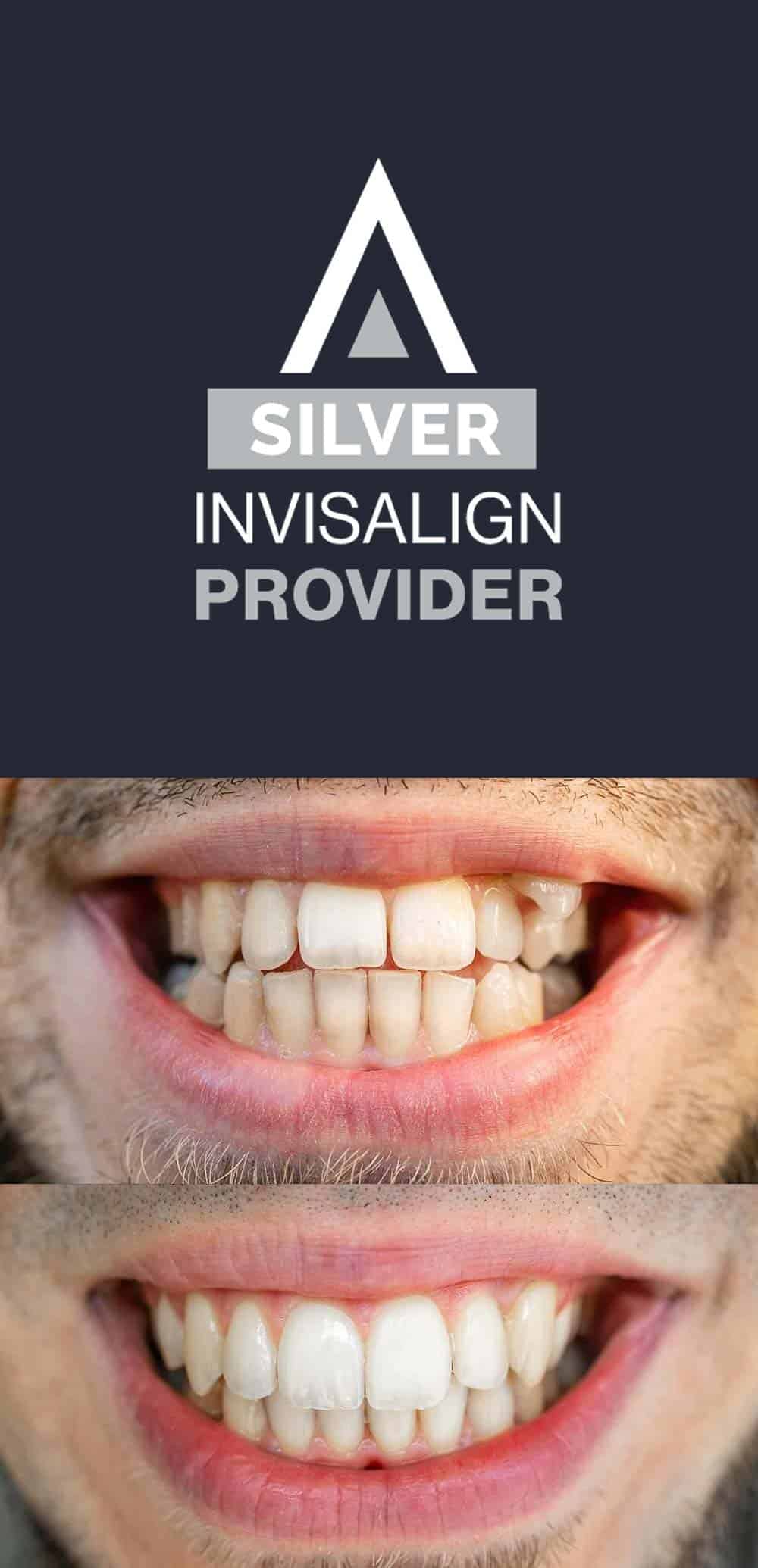 How does Invisalign work?